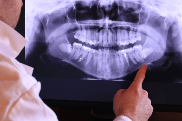 Best Emergency Tooth Extraction in Lemmon, SD